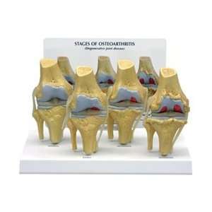 Stage Osteoarthritis Knee Joint Model  Industrial 