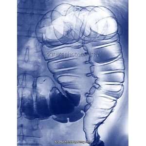  Large intestine, X ray Framed Prints